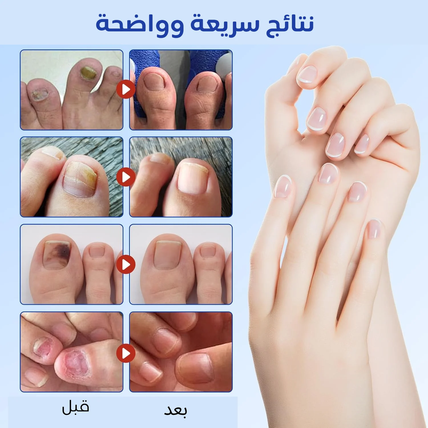 علاج فطريات الأظافر